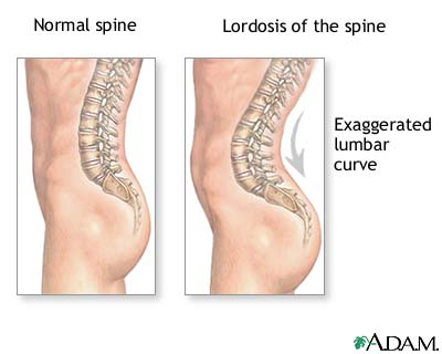 lordosis2.jpg