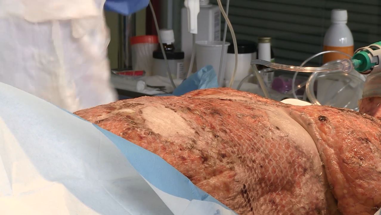 Proceso de cura de un paciente quemado